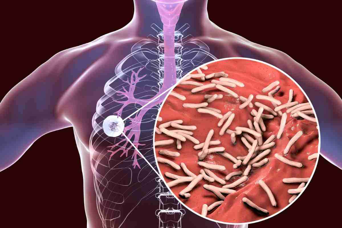 tubercolosi oms minaccia